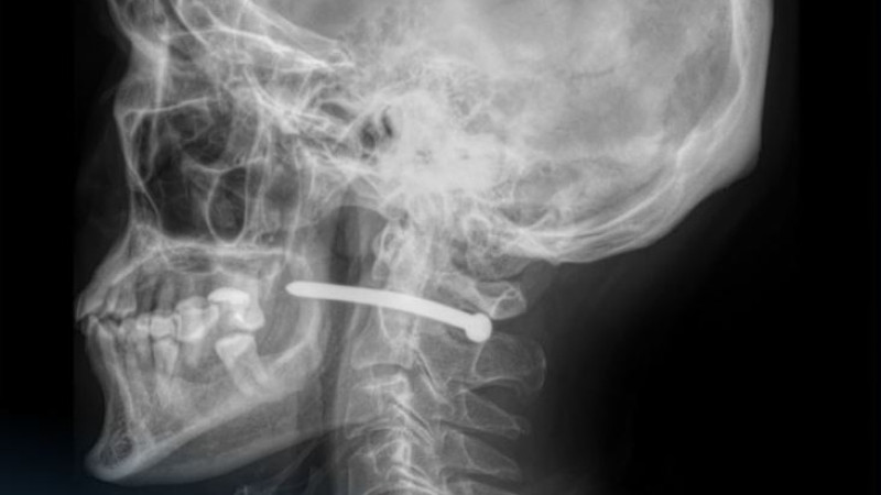 Гвоздь в шею: пневмопистолет стал оружием ремонта