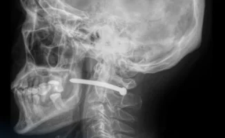 Гвоздь в шею: пневмопистолет стал оружием ремонта