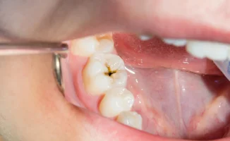 Крепче, чем зубная эмаль: учёные раскрыли секрет защиты от кариеса