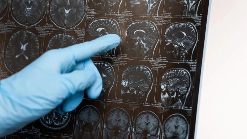 Время против разума: как нехватка минут ведет к деменции?