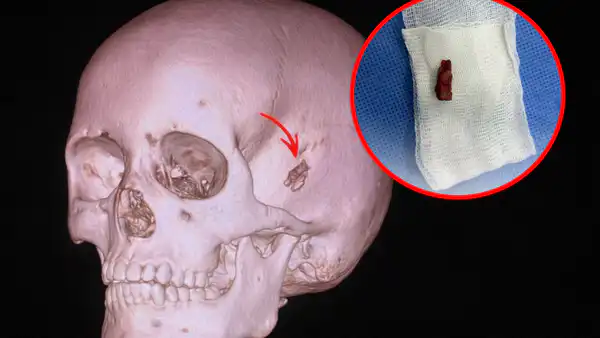 В Павлодаре у десятилетнего мальчика извлекли ветку из головы