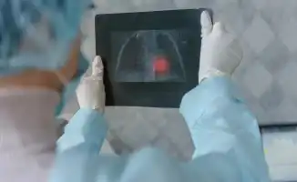 Туберкулёз среди студентов: кто под угрозой в вузах?