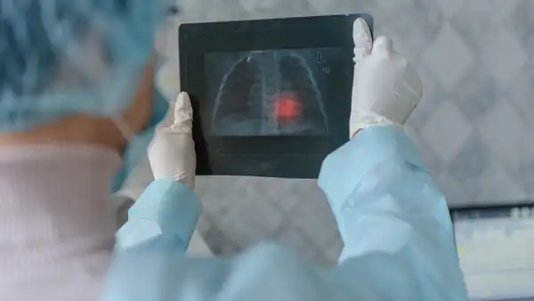 Туберкулёз среди студентов: кто под угрозой в вузах?