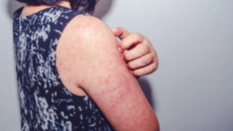 Снова вспышка кори в Казахстане: сотни заболевших детей