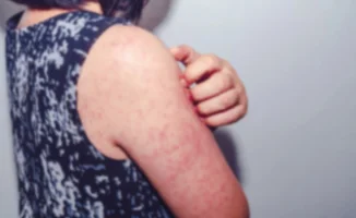 Снова вспышка кори в Казахстане: сотни заболевших детей