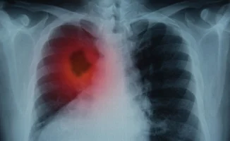 НДКТ-скрининг: эффективный метод диагностики агрессивного рака легкого