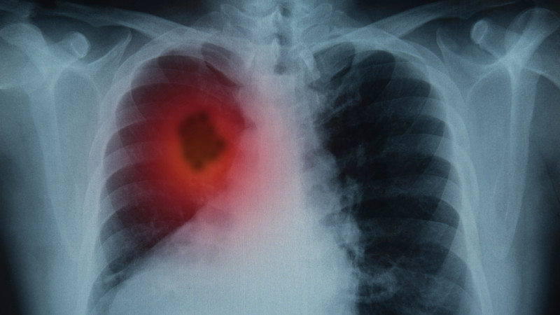 НДКТ-скрининг: эффективный метод диагностики агрессивного рака легкого