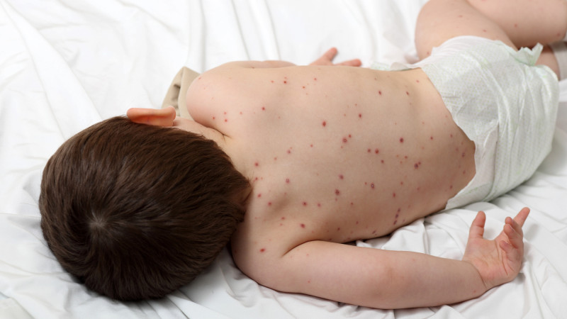 Вспышка кори в Казахстане: причины и последствия с 2019 года