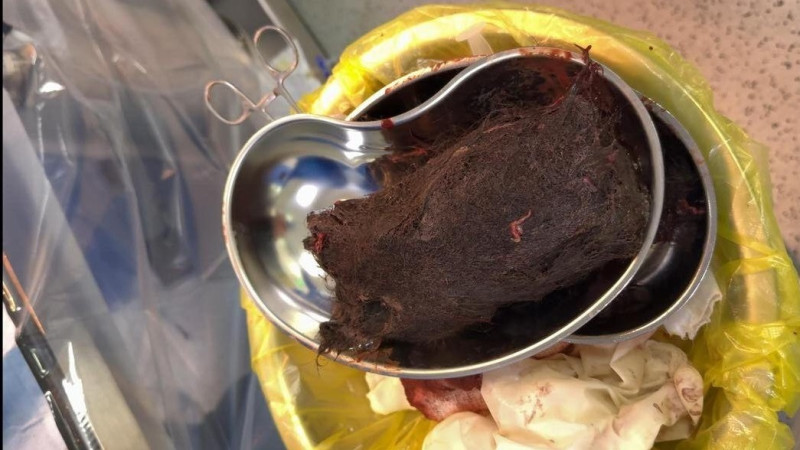 В желудке девочки нашли почти килограмм волос