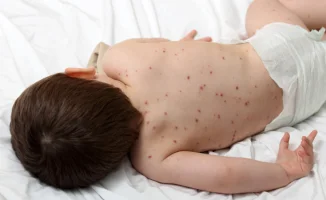 Вспышка кори в Казахстане: причины и последствия с 2019 года