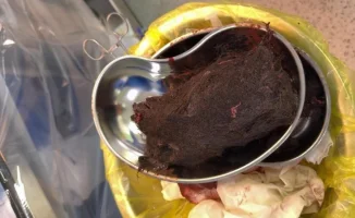 В желудке девочки нашли почти килограмм волос