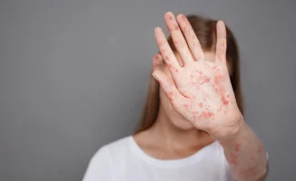 Минздрав усиливает борьбу с корью в стране