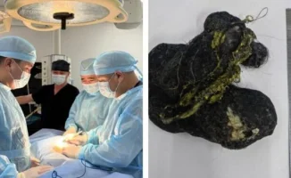 Шымкент: из желудка ребенка извлечен ком волос длиной 15 см