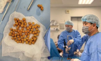 В Туркестане врачи удалили 80 камней из мочевого пузыря 61-летнего пациента из Казахстана