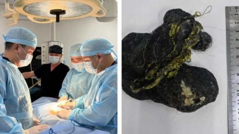 Шымкент: из желудка ребенка извлечен ком волос длиной 15 см