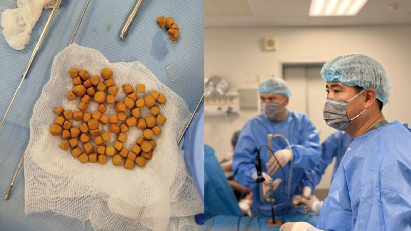 В Туркестане врачи удалили 80 камней из мочевого пузыря 61-летнего пациента из Казахстана