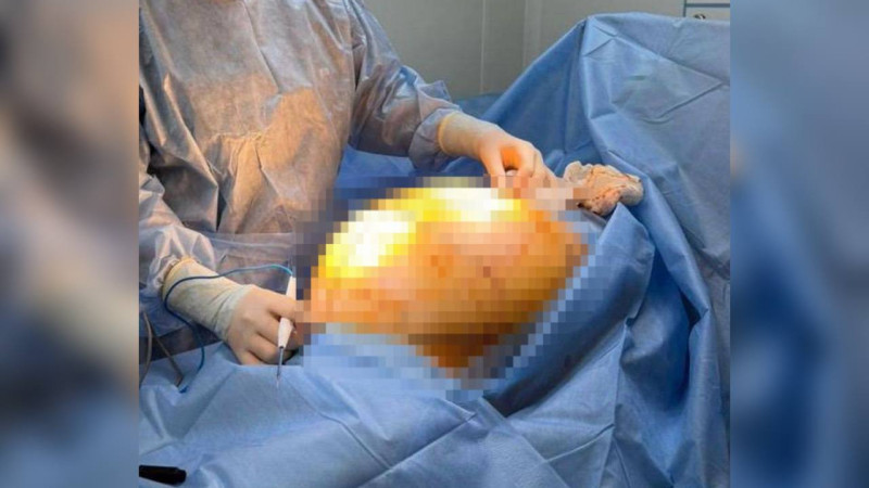 В Алматы пенсионерке удалили опухоль весом 25 кг, растущую за короткое время