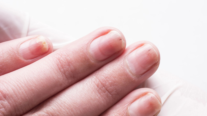 Врачи предупредили о симптомах рака, видимых невооружённым глазом