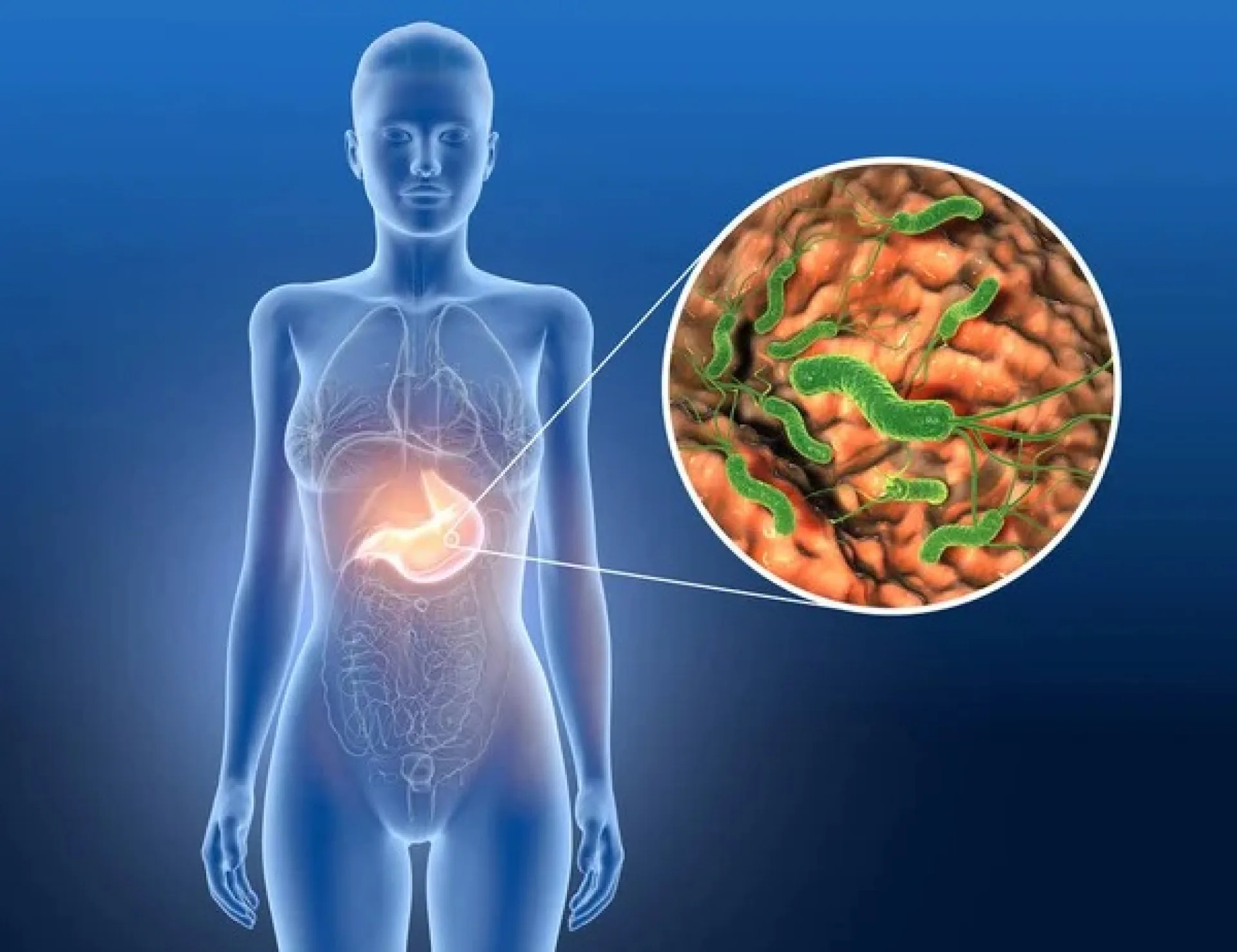 Хеликобактер пилори (Helicobacter pylori)